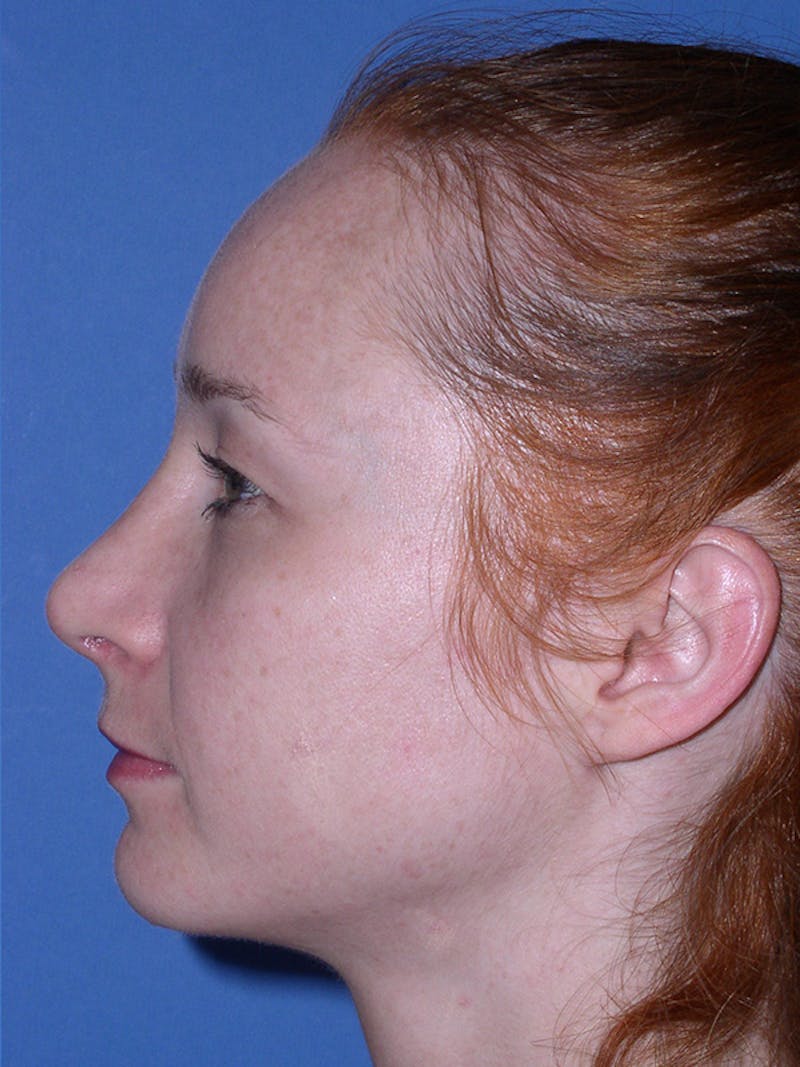 Rhinoplasty Before & After Gallery - Patient 179729367 - Image 10