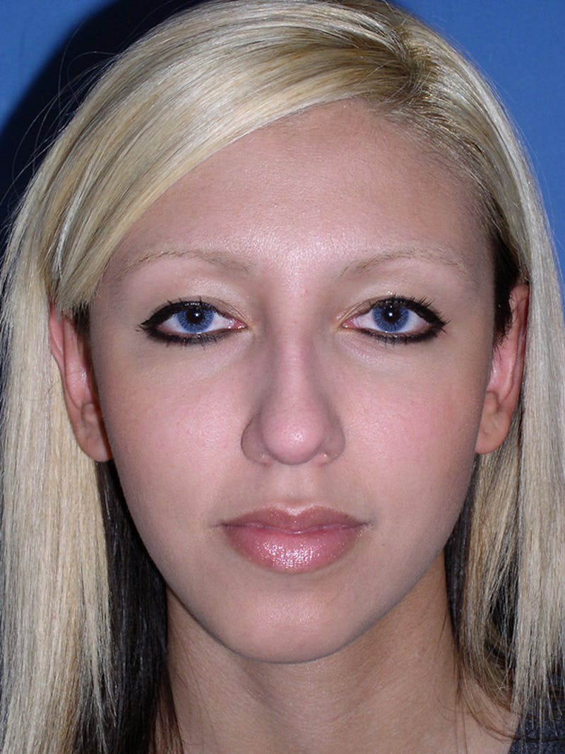 Rhinoplasty Before & After Gallery - Patient 179729366 - Image 1