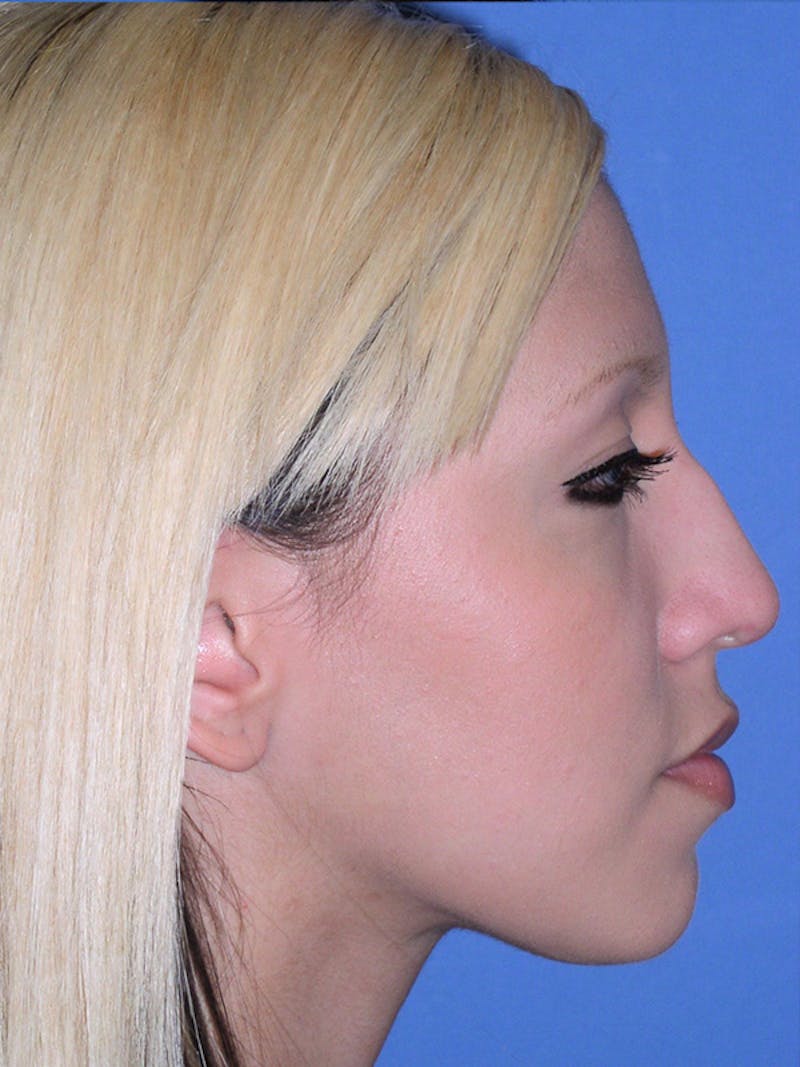 Rhinoplasty Before & After Gallery - Patient 179729366 - Image 3