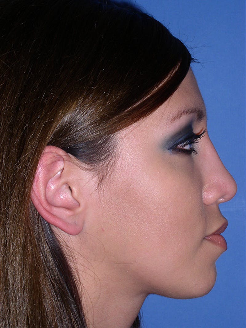 Rhinoplasty Before & After Gallery - Patient 179729366 - Image 4