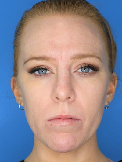 Volux Before & After Gallery - Patient 179729573 - Image 2
