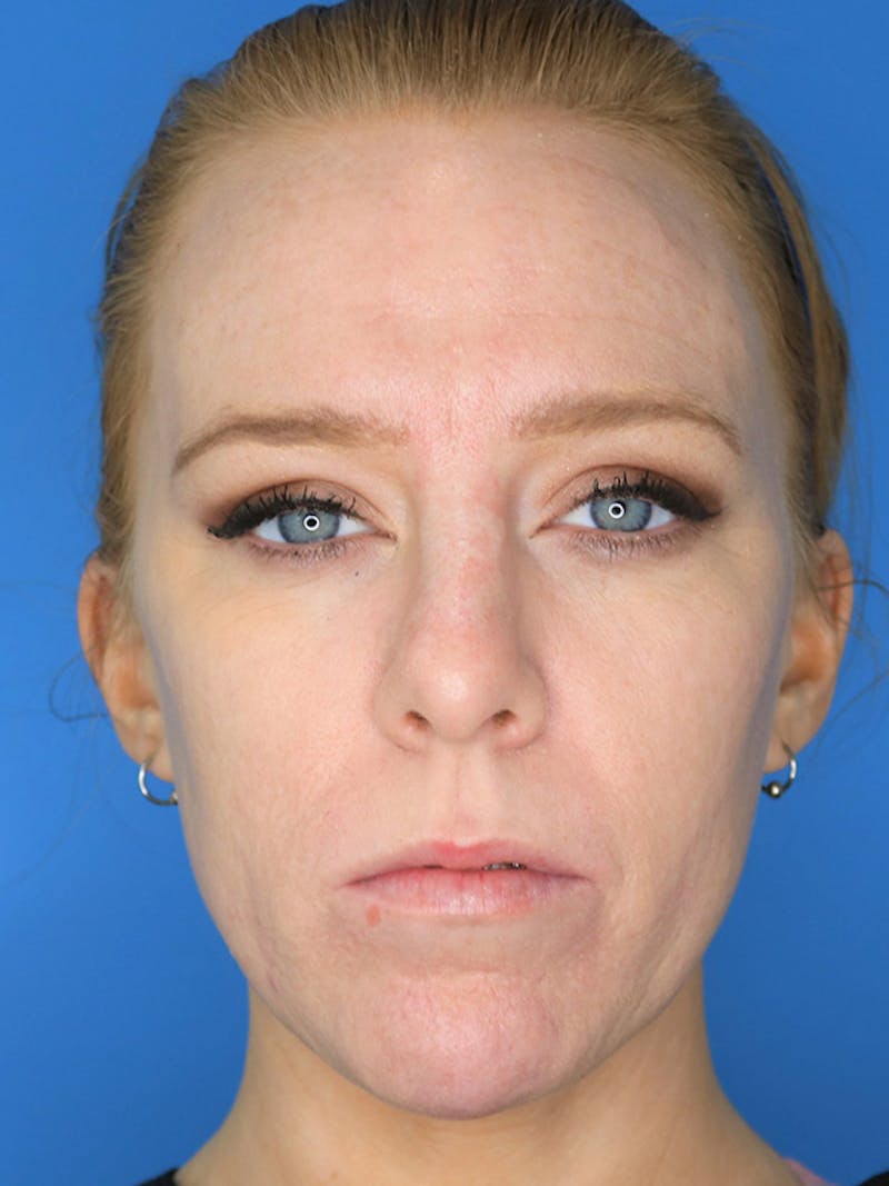 Volux Before & After Gallery - Patient 179729573 - Image 2