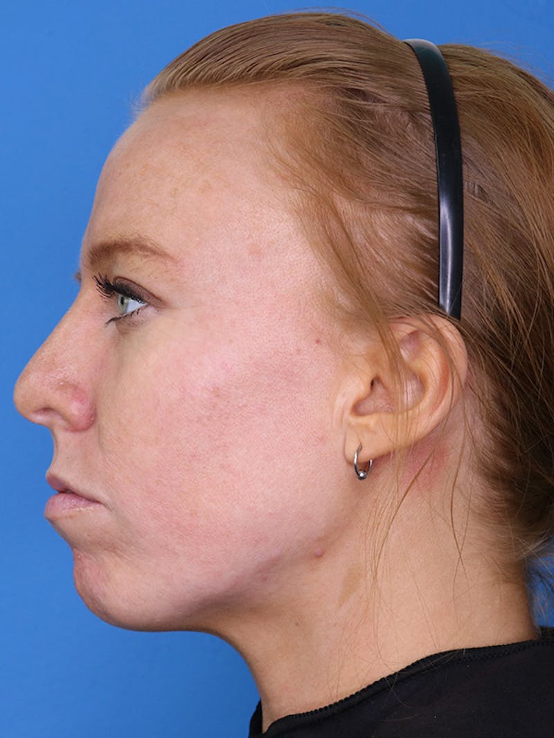 Volux Before & After Gallery - Patient 179729573 - Image 9