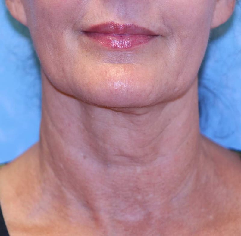 Sofwave Treatment Before & After Before & After Gallery - Patient 176764 - Image 2