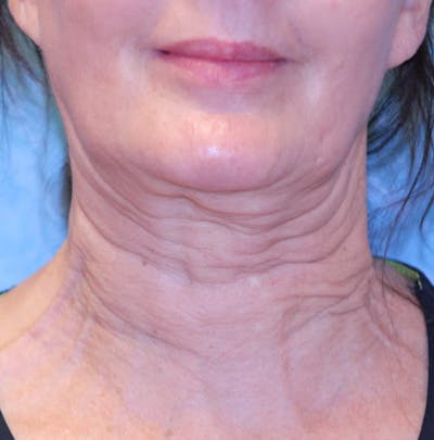 Sofwave Treatment Before & After Before & After Gallery - Patient 176764 - Image 1