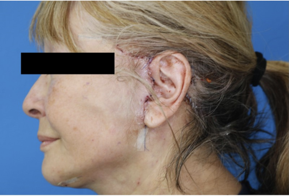 Before & After Deep Plane Facelift in Carlsbad, Vista & Oceanside