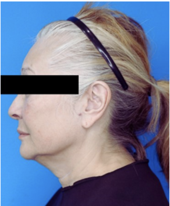 Before & After Deep Plane Facelift in Carlsbad, Vista & Oceanside