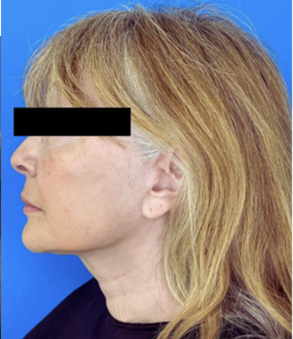 Before & After Deep Plane Facelift in Carlsbad, Vista & Oceanside