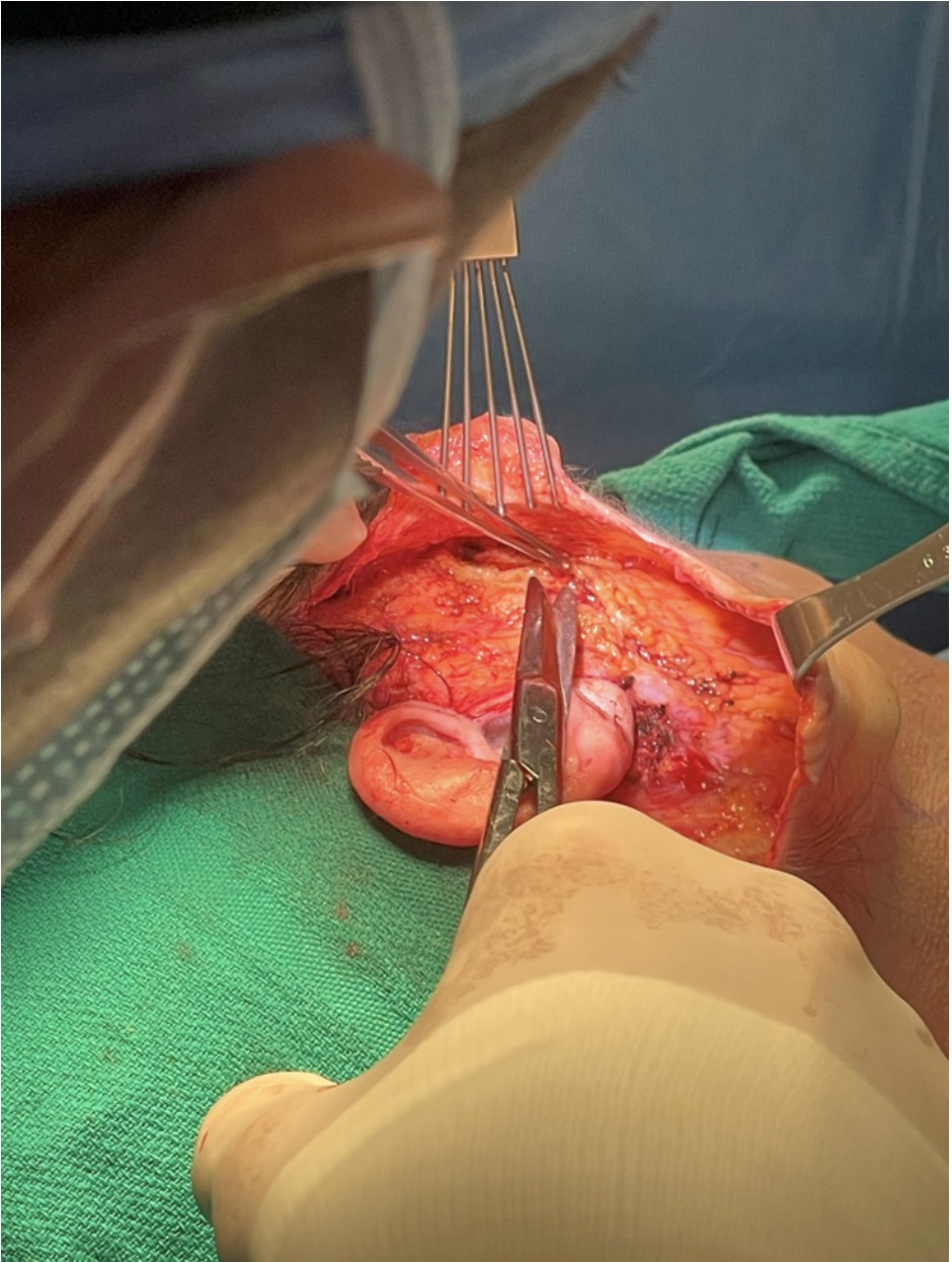 Deep Plane Facelift Surgery