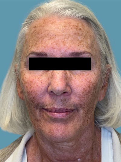 IPL and Pigment Therapy Before & After Gallery - Patient 148062 - Image 1