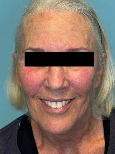 IPL and Pigment Therapy Before & After Gallery - Patient 148062 - Image 2