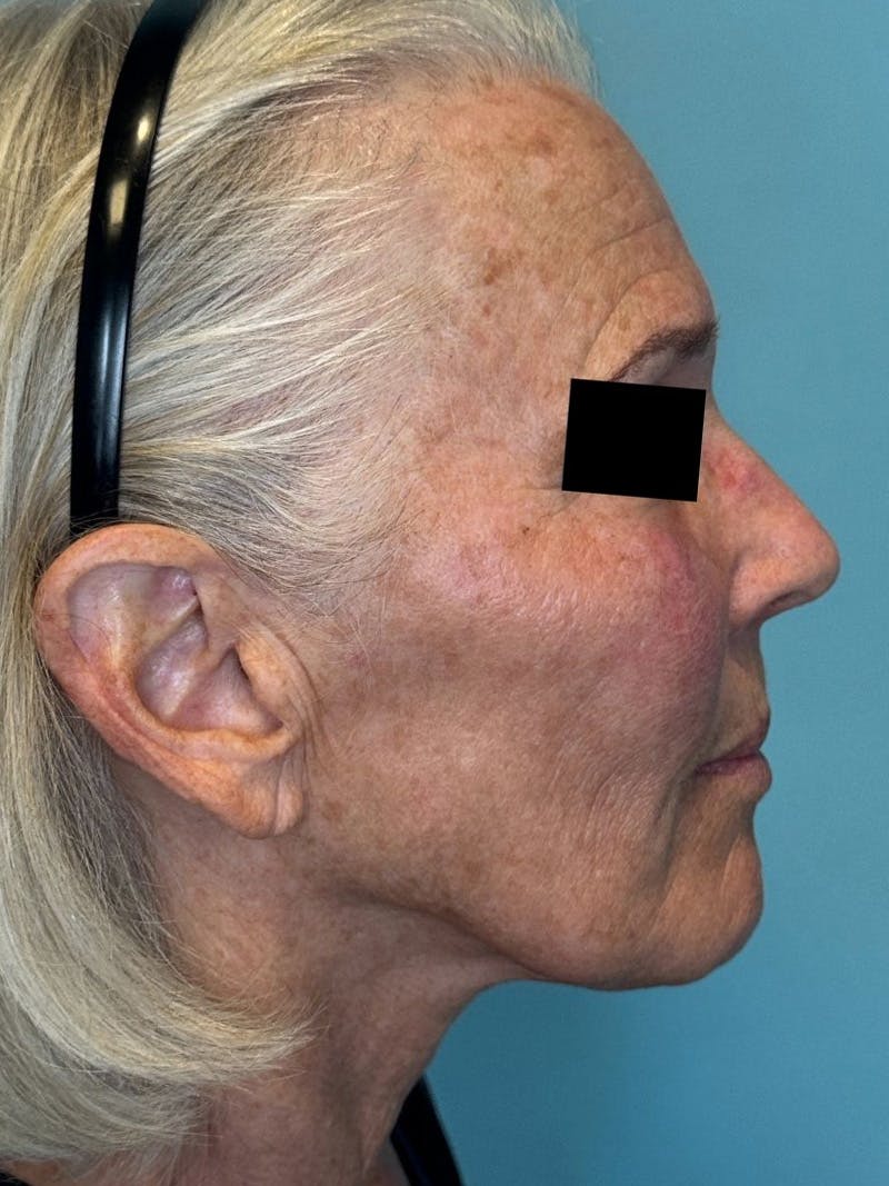 IPL and Pigment Therapy Before & After Gallery - Patient 148062 - Image 4