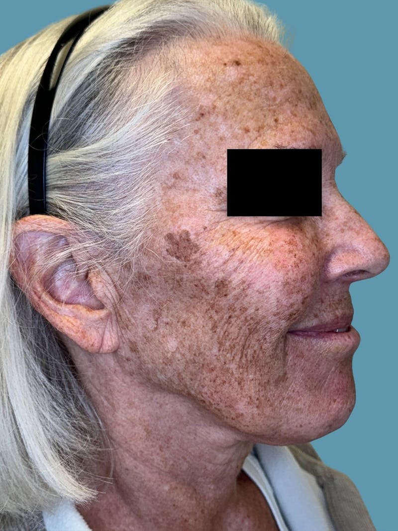 IPL and Pigment Therapy Before & After Gallery - Patient 148062 - Image 3