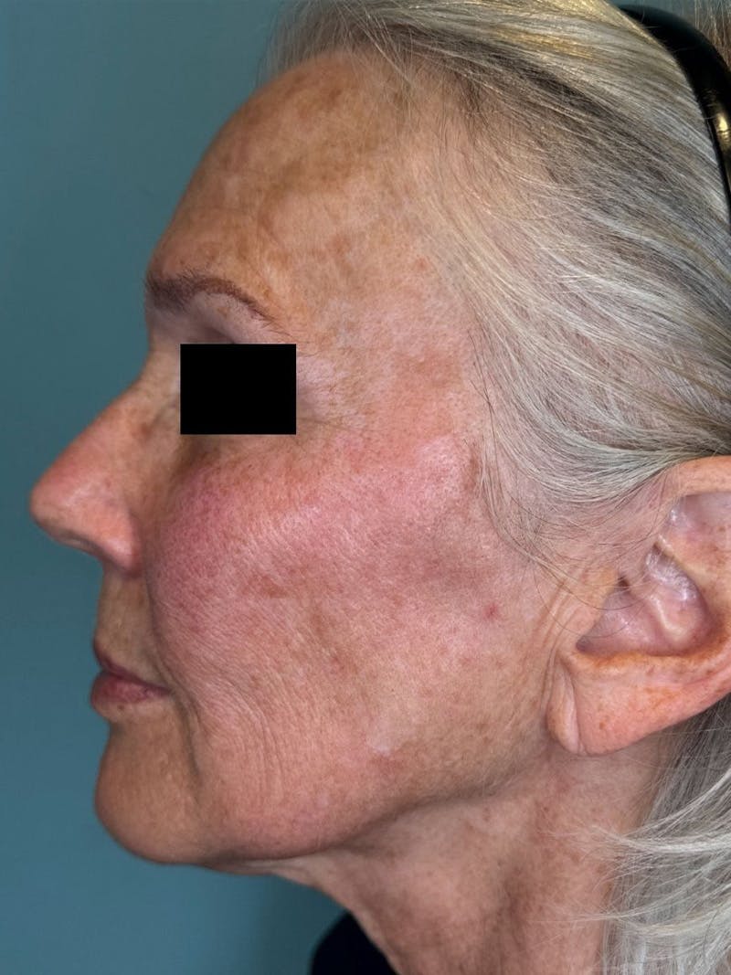 IPL and Pigment Therapy Before & After Gallery - Patient 148062 - Image 6