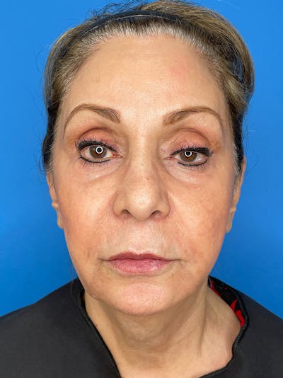 Deep Plane Lower Face and Neck Lift Before & After Gallery - Patient 159628 - Image 1