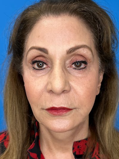 Deep Plane Lower Face and Neck Lift Before & After Gallery - Patient 159628 - Image 2