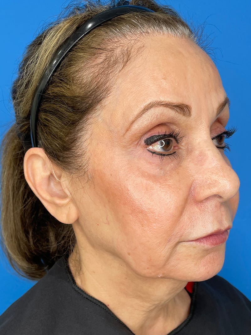 Deep Plane Lower Face and Neck Lift Before & After Gallery - Patient 159628 - Image 3