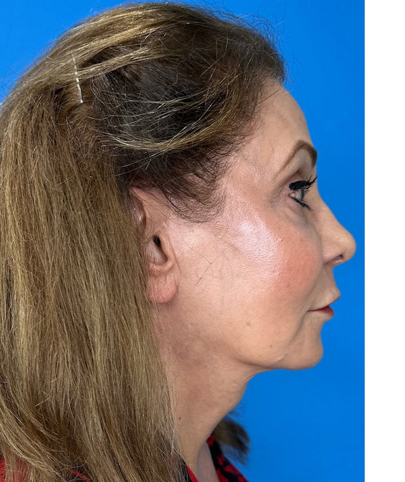 Deep Plane Lower Face and Neck Lift Before & After Gallery - Patient 159628 - Image 6