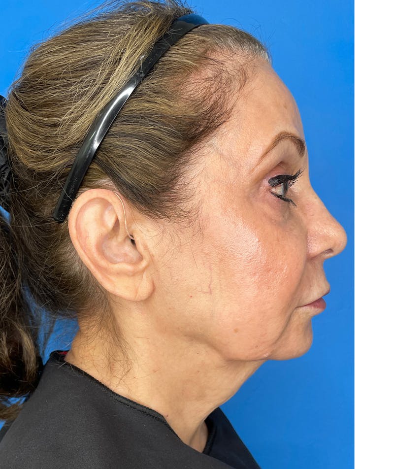 Deep Plane Lower Face and Neck Lift Before & After Gallery - Patient 159628 - Image 5