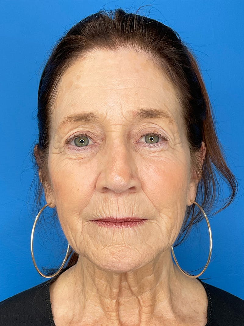 C02 Laser Resurfacing Before & After Gallery - Patient 125900 - Image 1