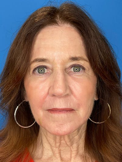C02 Laser Resurfacing Before & After Gallery - Patient 125900 - Image 2