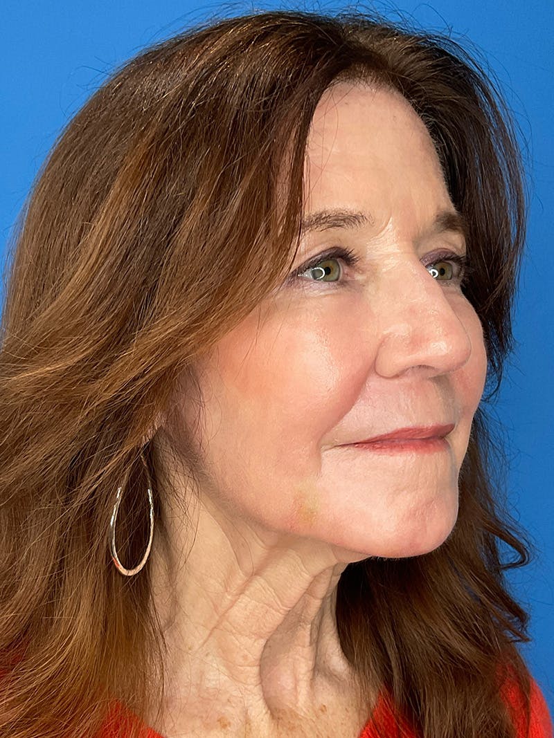C02 Laser Resurfacing Before & After Gallery - Patient 125900 - Image 4
