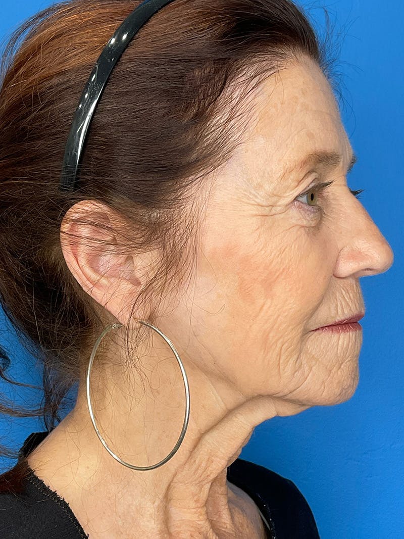 C02 Laser Resurfacing Before & After Gallery - Patient 125900 - Image 5