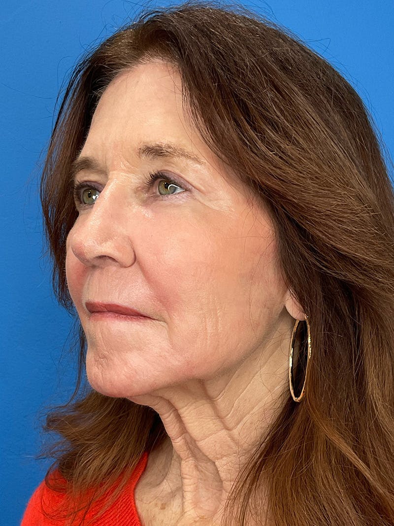 C02 Laser Resurfacing Before & After Gallery - Patient 125900 - Image 8