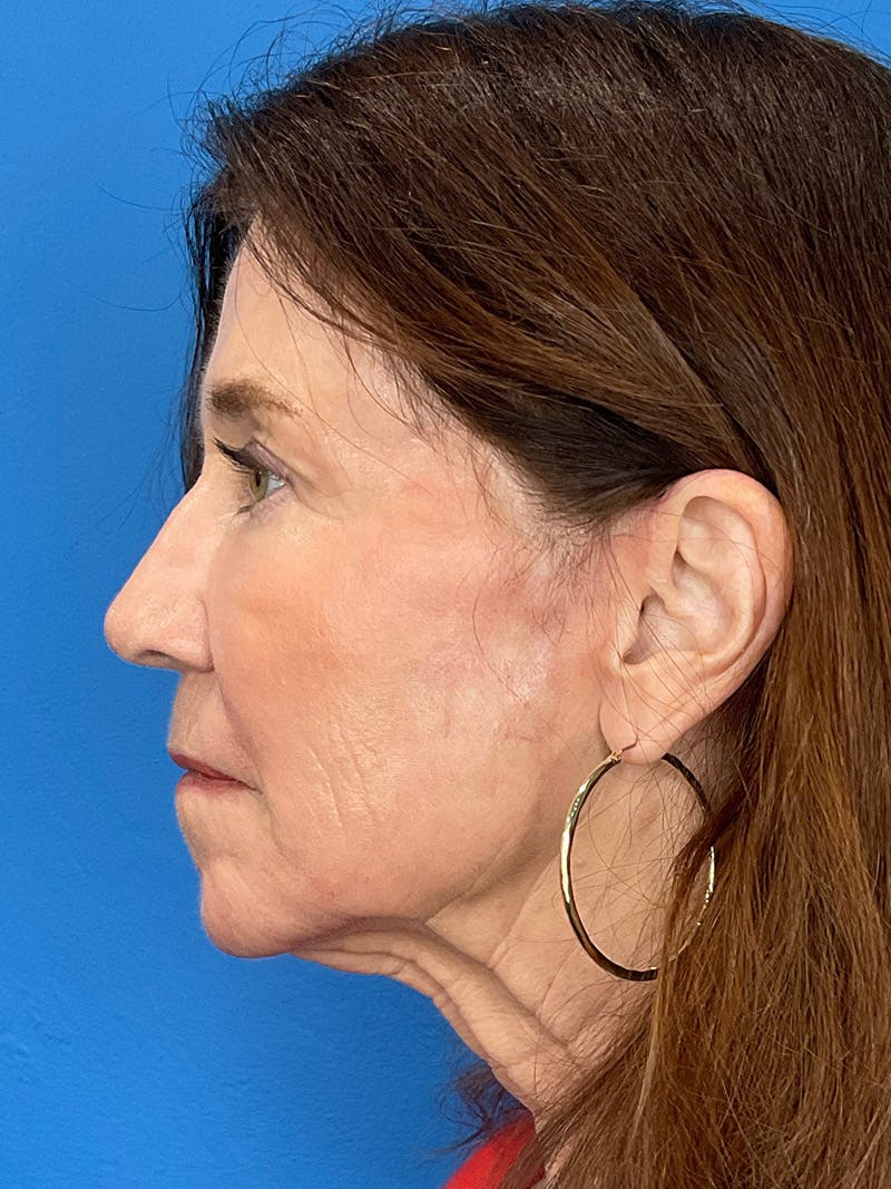 C02 Laser Resurfacing Before & After Gallery - Patient 125900 - Image 10