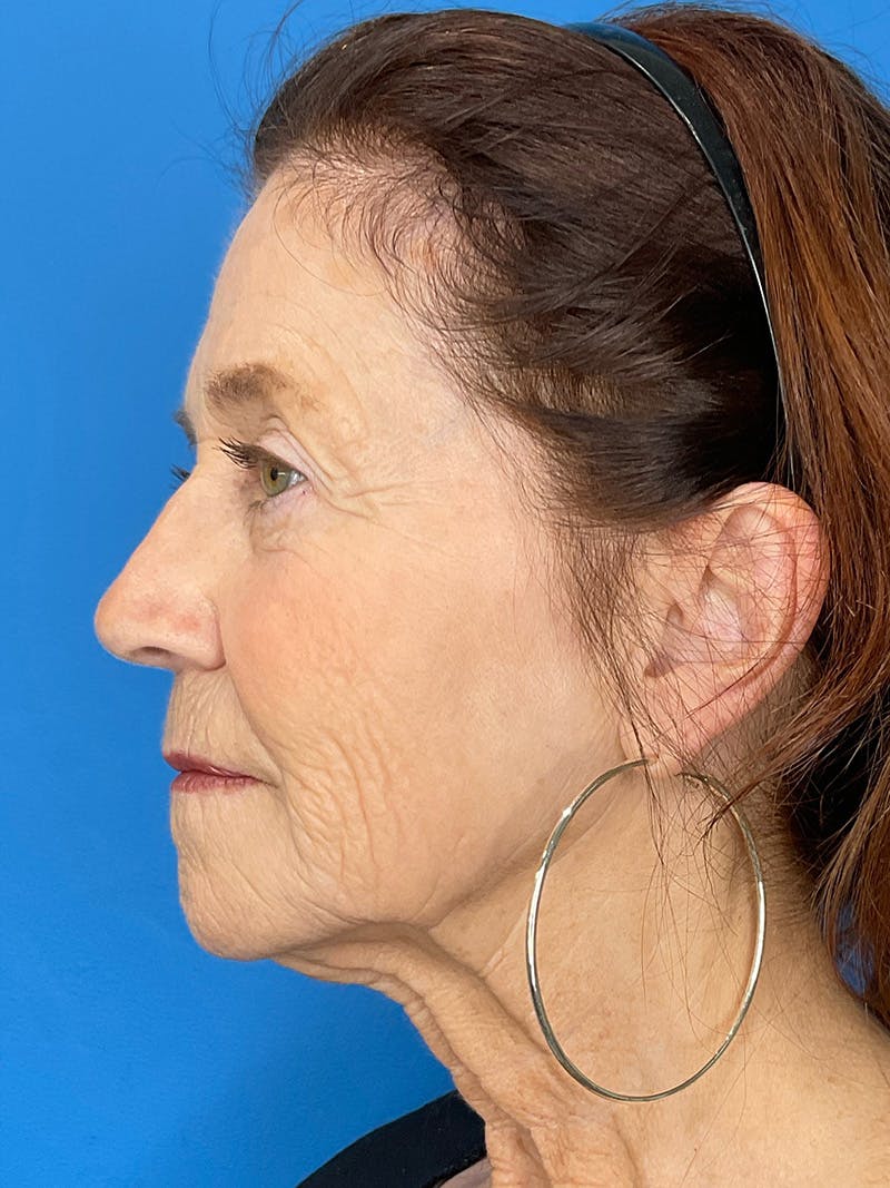 C02 Laser Resurfacing Before & After Gallery - Patient 125900 - Image 9