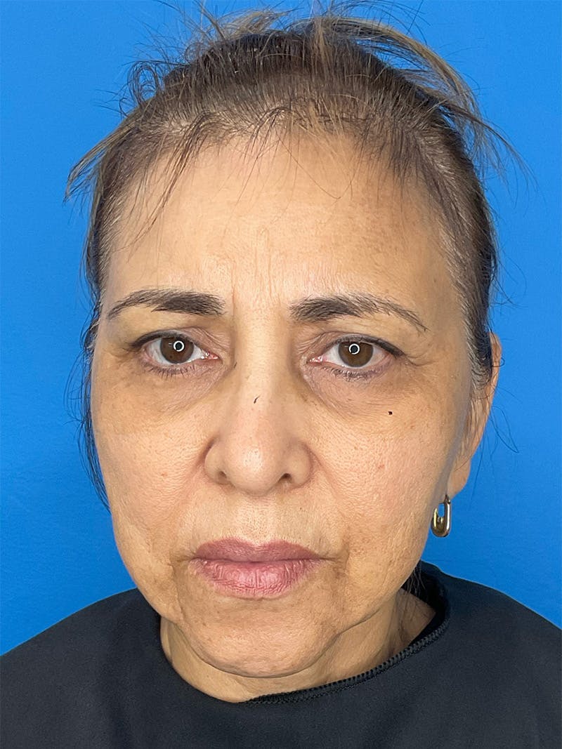 Chin Augmentation Before & After Gallery - Patient 506403 - Image 5