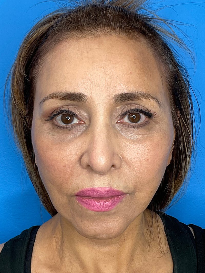 Chin Augmentation Before & After Gallery - Patient 506403 - Image 6