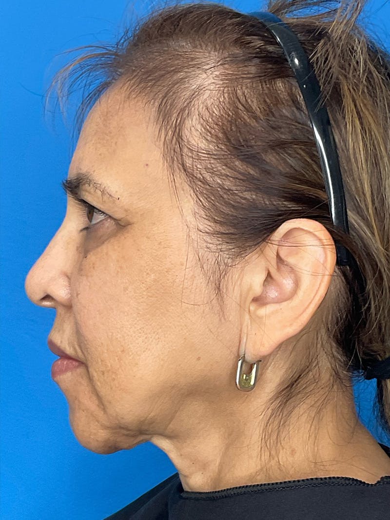 Chin Augmentation Before & After Gallery - Patient 506403 - Image 3