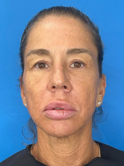 Brow Lift Before & After Gallery - Patient 274393 - Image 1