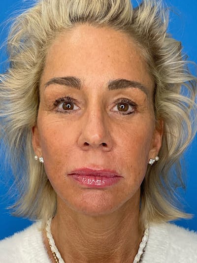 Brow Lift Before & After Gallery - Patient 274393 - Image 2