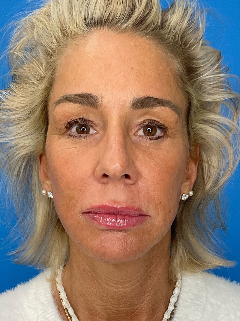 Brow Lift Before & After Gallery - Patient 274393 - Image 2
