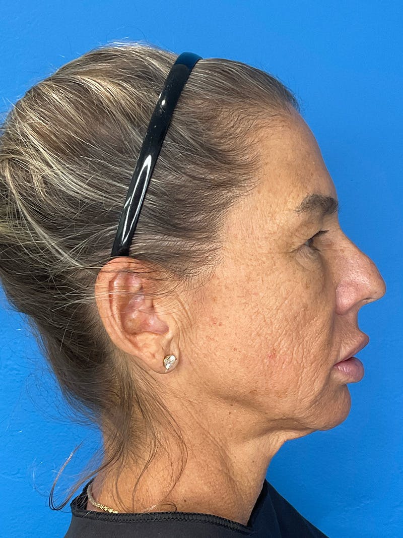 Brow Lift Before & After Gallery - Patient 274393 - Image 5