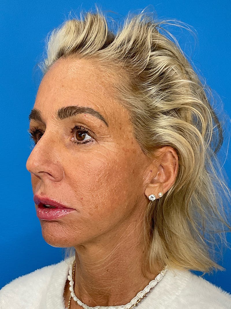 Brow Lift Before & After Gallery - Patient 274393 - Image 8