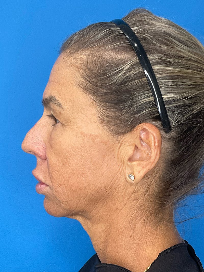 Brow Lift Before & After Gallery - Patient 274393 - Image 9