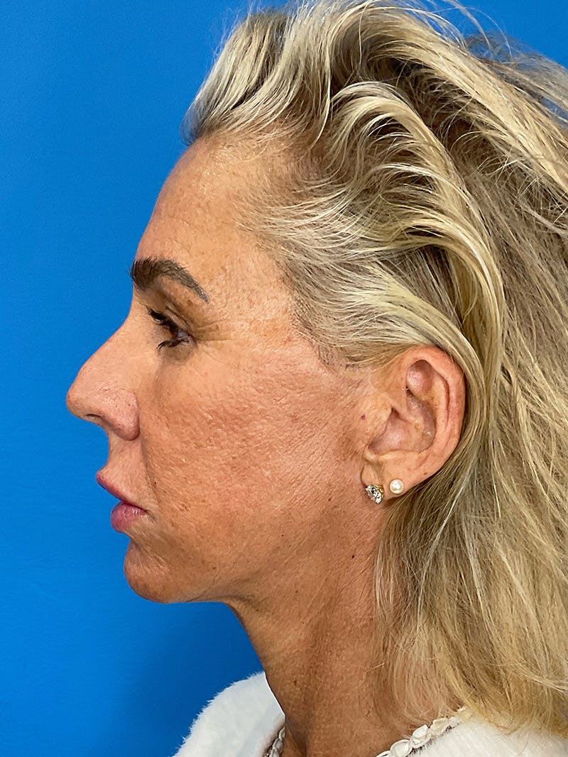 Brow Lift Before & After Gallery - Patient 274393 - Image 10