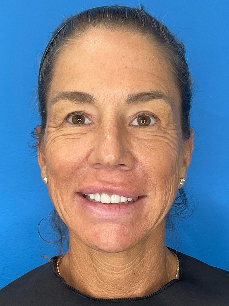 Brow Lift Before & After Gallery - Patient 274393 - Image 3