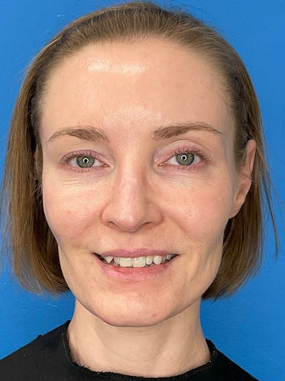 Facial Fat Transfer Before & After Gallery - Patient 623319 - Image 1