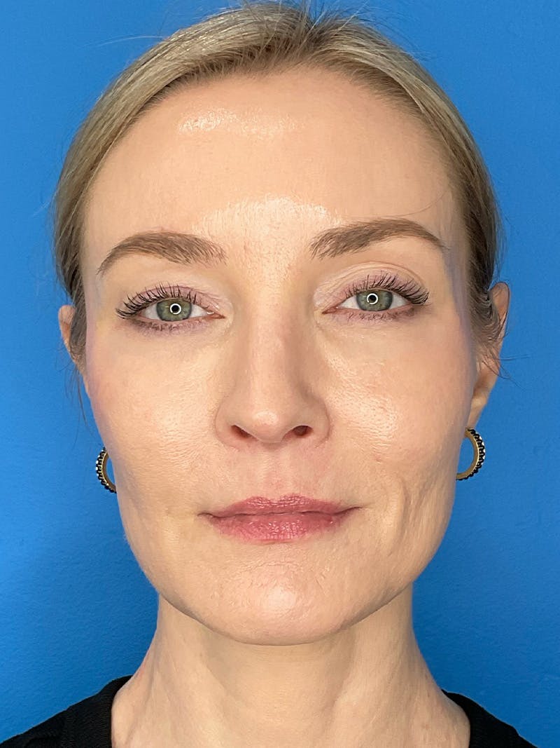 Facial Fat Transfer Before & After Gallery - Patient 623319 - Image 2