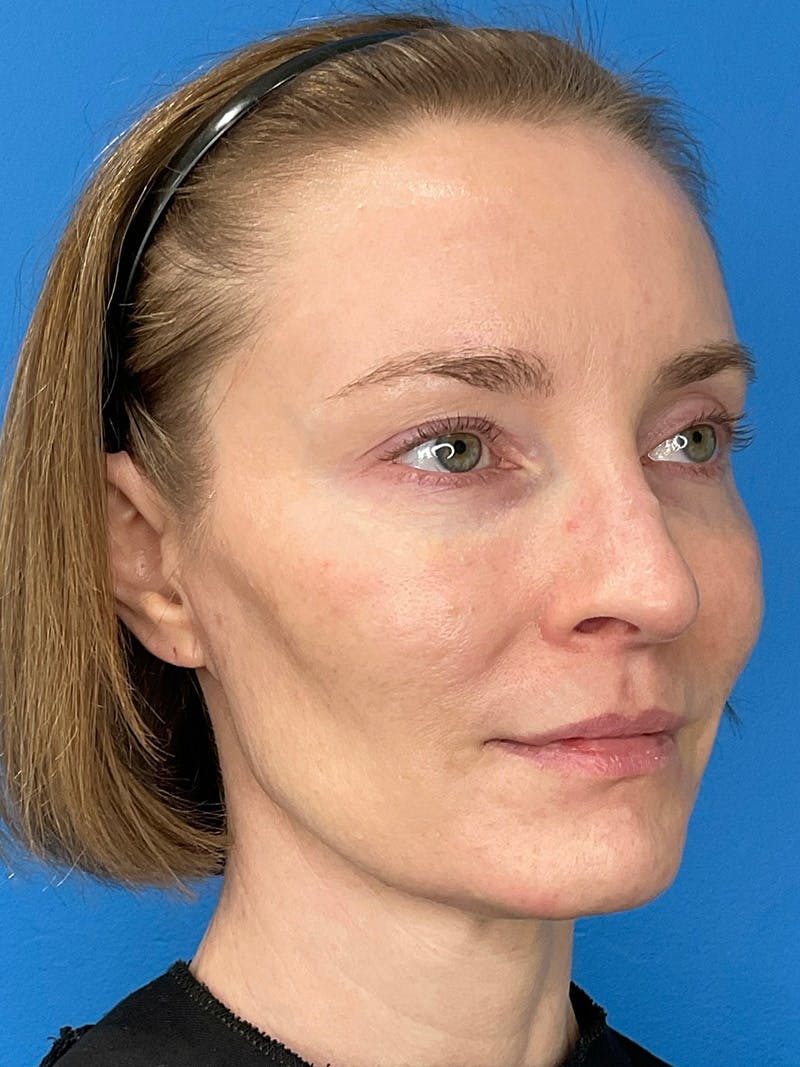 Facial Fat Transfer Before & After Gallery - Patient 623319 - Image 3