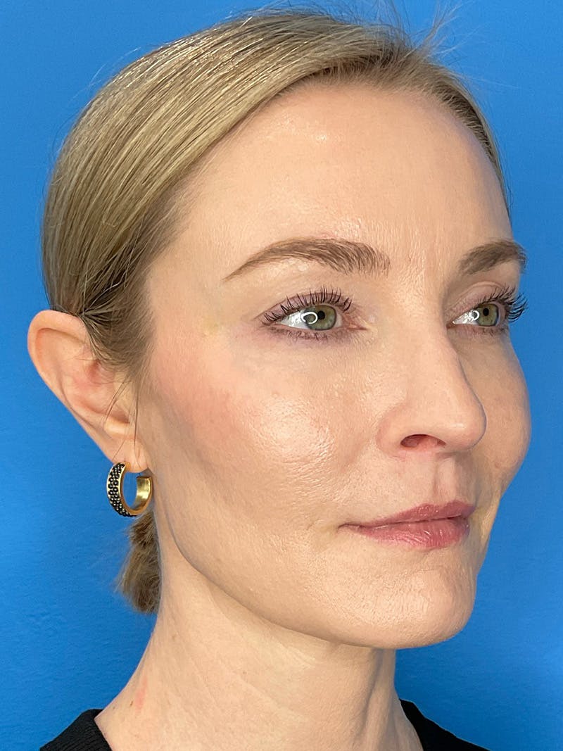 Facial Fat Transfer Before & After Gallery - Patient 623319 - Image 4