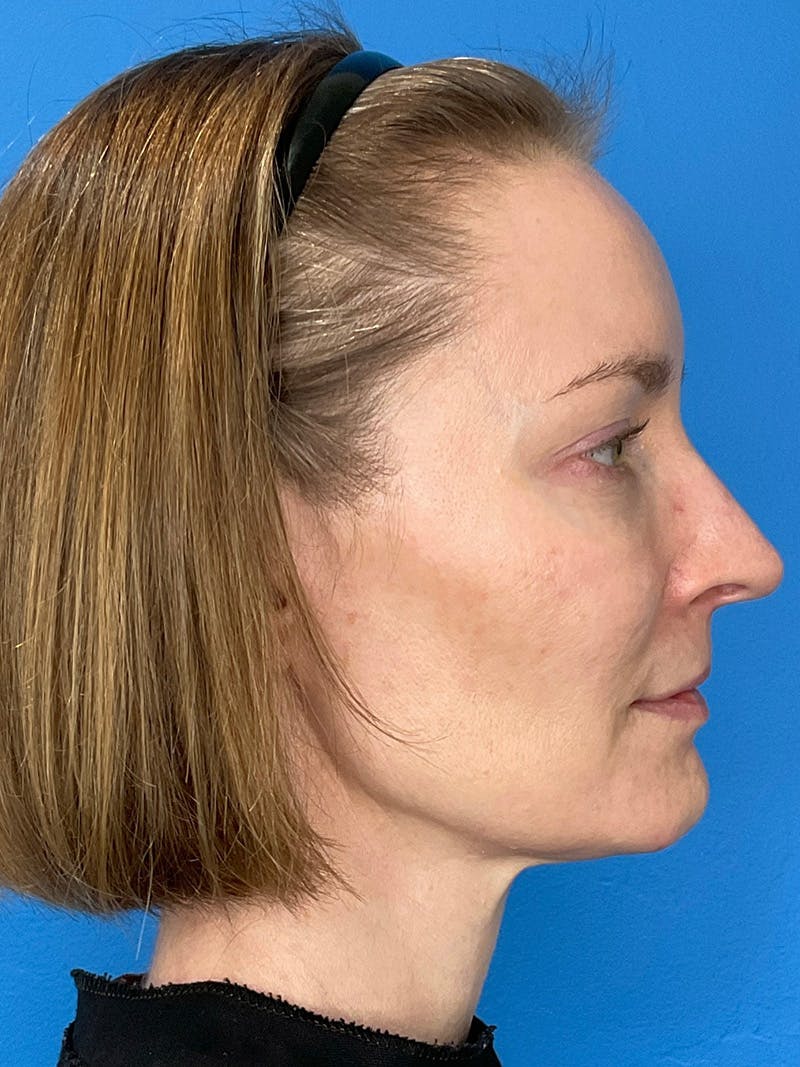 Facial Fat Transfer Before & After Gallery - Patient 623319 - Image 5