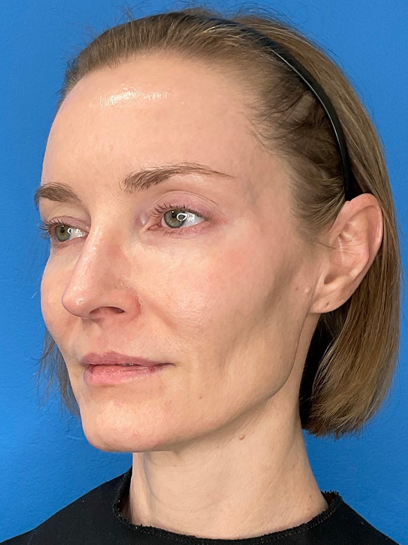 Facial Fat Transfer Before & After Gallery - Patient 623319 - Image 7