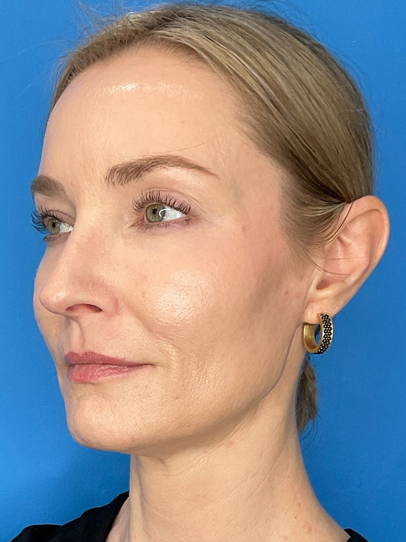 Facial Fat Transfer Before & After Gallery - Patient 623319 - Image 8