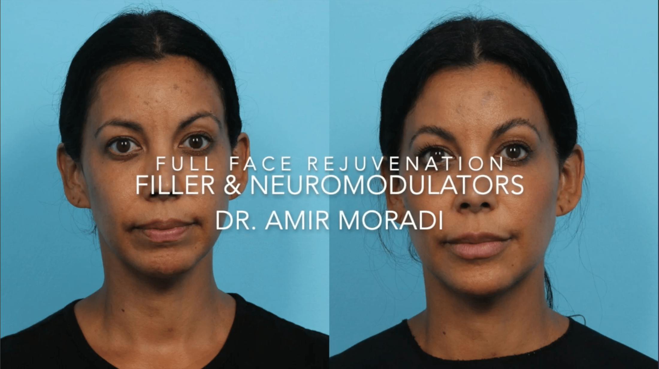 Facial fillers before and after