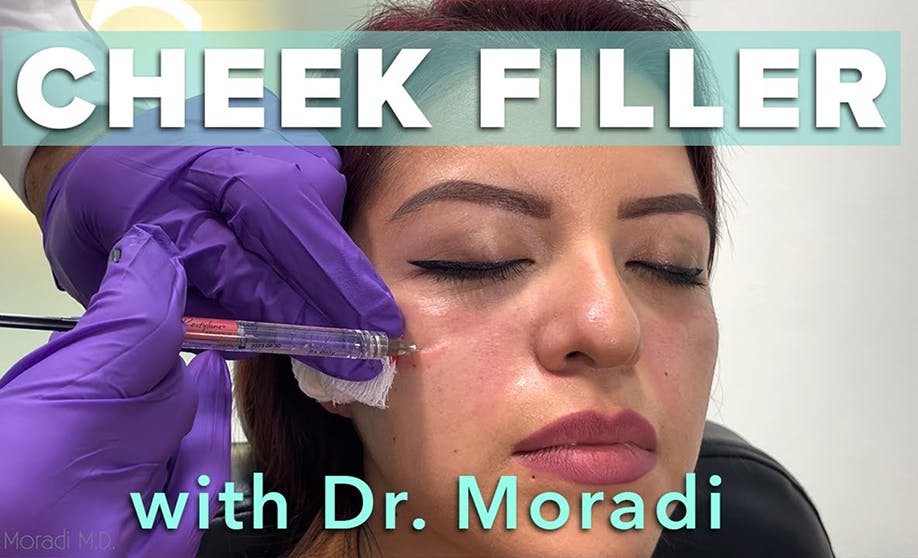 Watch This Patient Get Cheek Filler! Before & After Restylane Contour